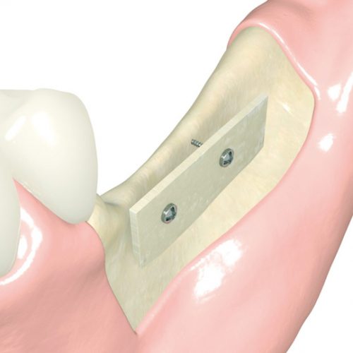 botiss-maxgraft-cortico-003p